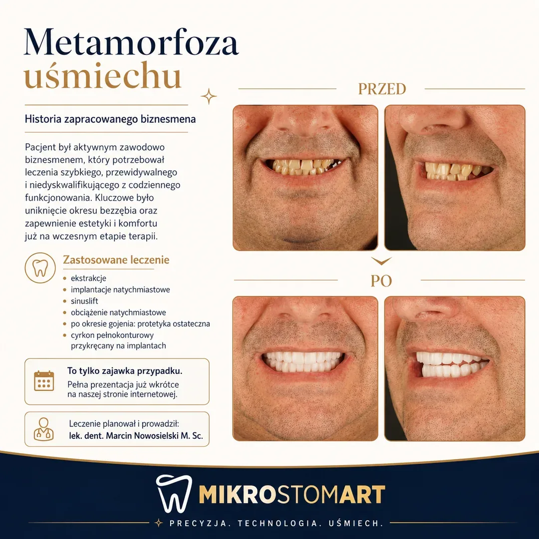 Przykładowy przypadek All-on-X z obciążeniem natychmiastowym — przed i po: ekstrakcje, implantacje natychmiastowe, sinuslift, most z cyrkonu na implantach
